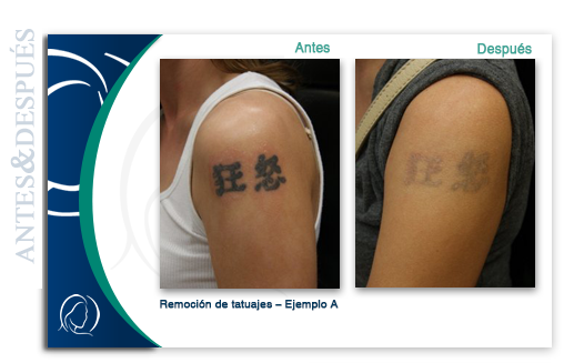 Dermatología láser para eliminación de tatuajes en Hollywood FL