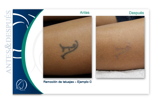 Remoción de tatuajes antes y después