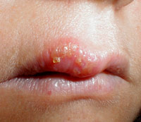 Herpes Labiales (Úlceras Bucales)
